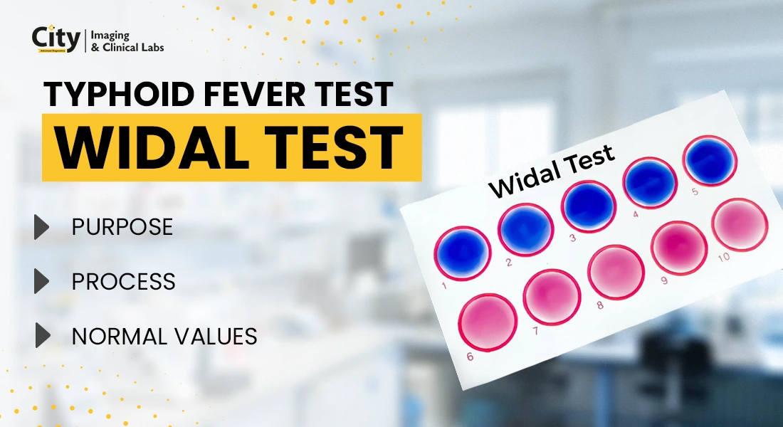 Typhoid Fever and Widal Test - Purpose and Normal Range